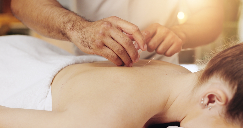 image of a woman getting acupuncture in her back