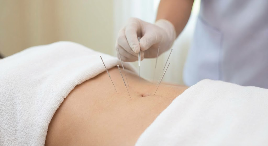 image of a woman getting acupuncture in her stomach